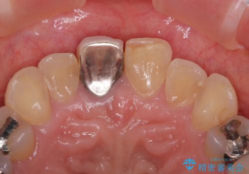 不自然な色彩の前歯 オールセラミッククラウンで自然な口元にの治療前