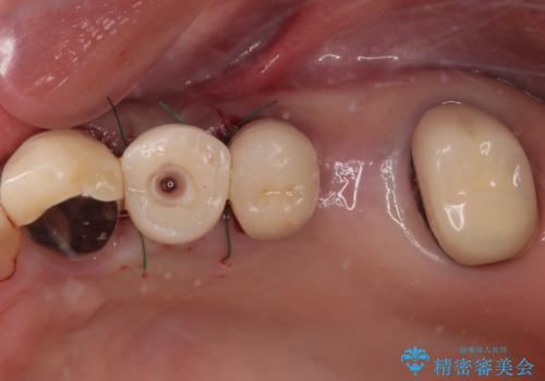 抜歯が必要な歯をインプラントに 短期間インプラント治療の治療中