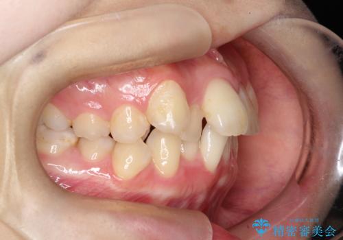 歯のデコボコ|口ボコ|八重歯が気になる!|ワイヤー矯正の治療前