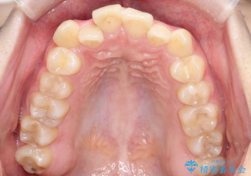歯のデコボコ|口ボコ|八重歯が気になる!|ワイヤー矯正の治療前