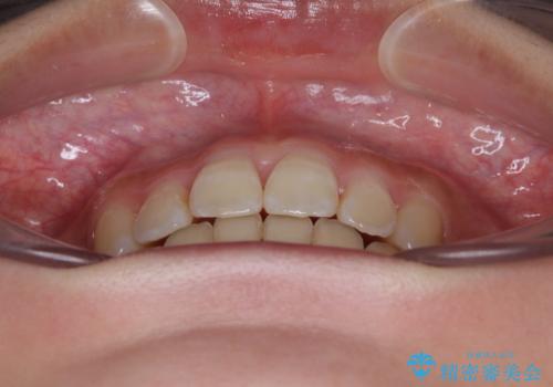 急速拡大装置 狭い骨幅を拡大した上で、口元の突出感を改善する抜歯矯正治療の治療後