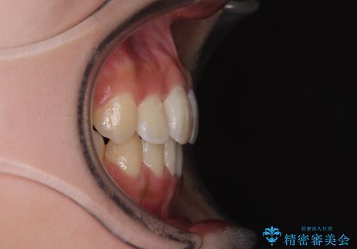 急速拡大装置 狭い骨幅を拡大した上で、口元の突出感を改善する抜歯矯正治療の治療後