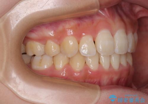 急速拡大装置 狭い骨幅を拡大した上で、口元の突出感を改善する抜歯矯正治療の治療後