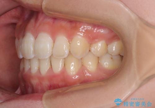 急速拡大装置 狭い骨幅を拡大した上で、口元の突出感を改善する抜歯矯正治療の治療後