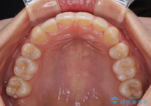 急速拡大装置 狭い骨幅を拡大した上で、口元の突出感を改善する抜歯矯正治療の治療後
