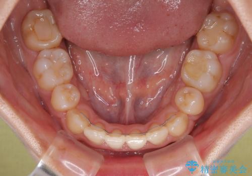 急速拡大装置 狭い骨幅を拡大した上で、口元の突出感を改善する抜歯矯正治療の治療後