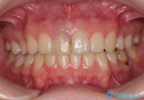 神経を取って変色した歯 オールセラミッククラウンで綺麗に仕上げるの治療前