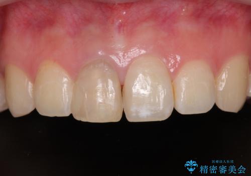 神経を取って変色した歯 オールセラミッククラウンで綺麗に仕上げるの症例 治療前