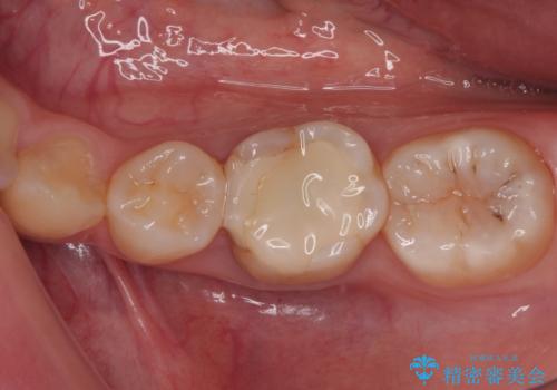 神経を取って変色した歯 オールセラミッククラウンで綺麗に仕上げるの治療前