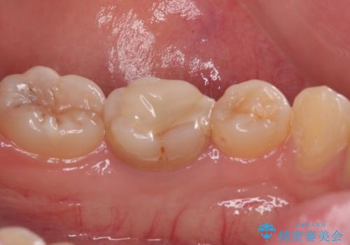 神経を取って変色した歯 オールセラミッククラウンで綺麗に仕上げるの治療前
