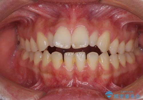 飛び出した前歯 インビザラインを用いた抜歯矯正治療の治療前