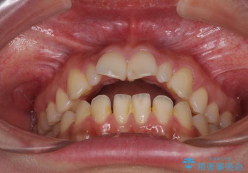飛び出した前歯 インビザラインを用いた抜歯矯正治療の治療前