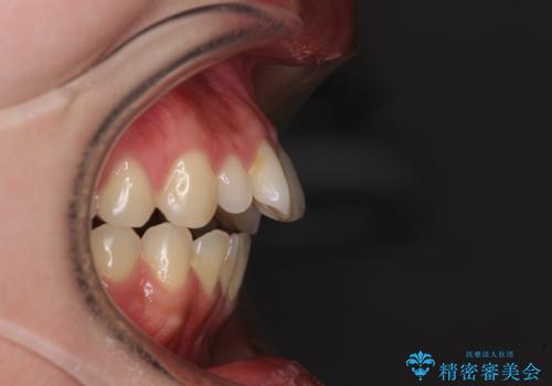 飛び出した前歯 インビザラインを用いた抜歯矯正治療の治療前