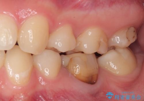 神経を取って変色した歯 オールセラミッククラウンで綺麗に仕上げるの治療前