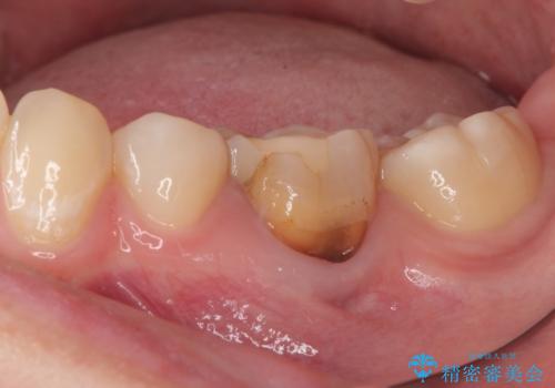 神経を取って変色した歯 オールセラミッククラウンで綺麗に仕上げるの治療前