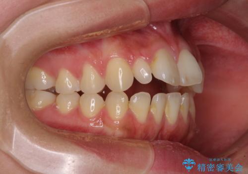 飛び出した前歯 インビザラインを用いた抜歯矯正治療の治療前