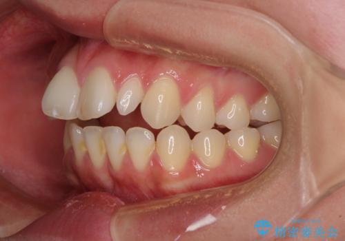 飛び出した前歯 インビザラインを用いた抜歯矯正治療の治療前