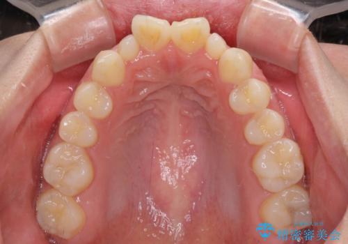 飛び出した前歯 インビザラインを用いた抜歯矯正治療の治療前