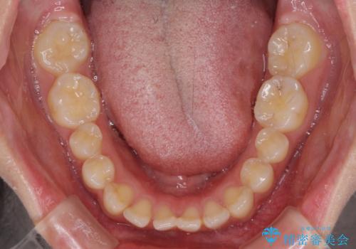 飛び出した前歯 インビザラインを用いた抜歯矯正治療の治療前