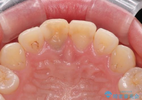 神経を取って変色した歯 オールセラミッククラウンで綺麗に仕上げるの治療前