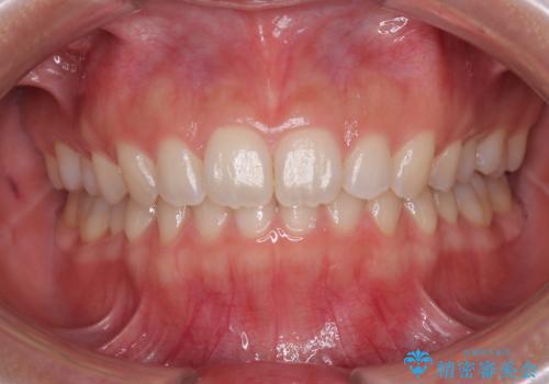 補助装置を併用して確実に インビザラインで奥歯の咬み合わせをしっかりと改善の症例 治療後