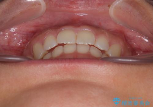 補助装置を併用して確実に インビザラインで奥歯の咬み合わせをしっかりと改善の治療後