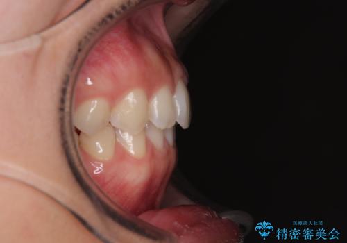 補助装置を併用して確実に インビザラインで奥歯の咬み合わせをしっかりと改善の治療後