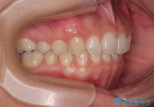 補助装置を併用して確実に インビザラインで奥歯の咬み合わせをしっかりと改善の治療後