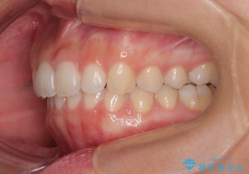 補助装置を併用して確実に インビザラインで奥歯の咬み合わせをしっかりと改善の治療後