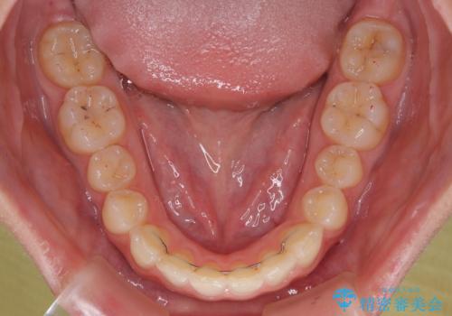 補助装置を併用して確実に インビザラインで奥歯の咬み合わせをしっかりと改善の治療後