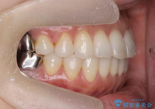 抜歯をせず前歯の角度を改善するマウスピース矯正治療の治療後