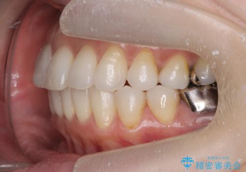 抜歯をせず前歯の角度を改善するマウスピース矯正治療の治療後