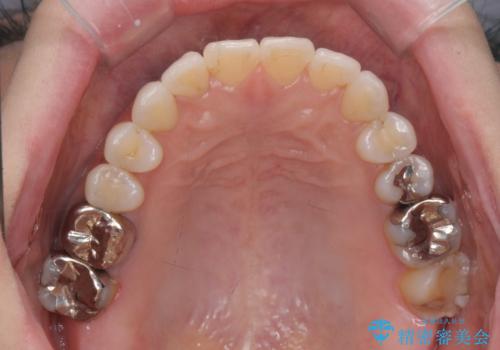 抜歯をせず前歯の角度を改善するマウスピース矯正治療の治療後