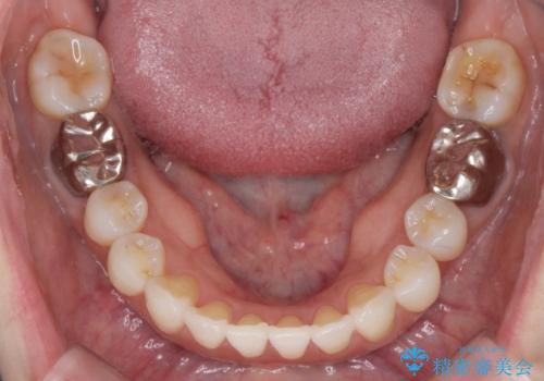 抜歯をせず前歯の角度を改善するマウスピース矯正治療の治療後