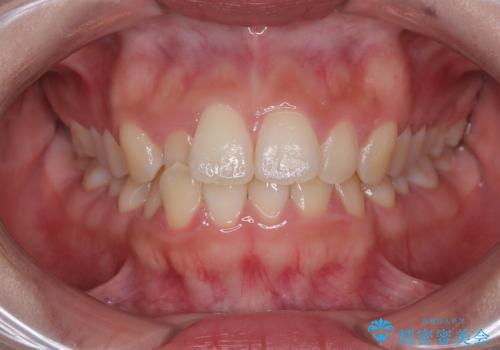 目立ちにくい表側装置で1年完了!狭いアーチを側方拡大し前歯のデコボコを整えた症例の症例 治療前