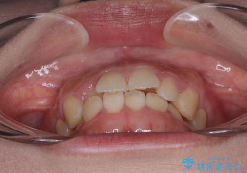 目立ちにくい表側装置で1年完了!狭いアーチを側方拡大し前歯のデコボコを整えた症例の治療前