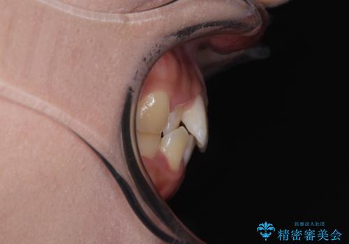 目立ちにくい表側装置で1年完了!狭いアーチを側方拡大し前歯のデコボコを整えた症例の治療前