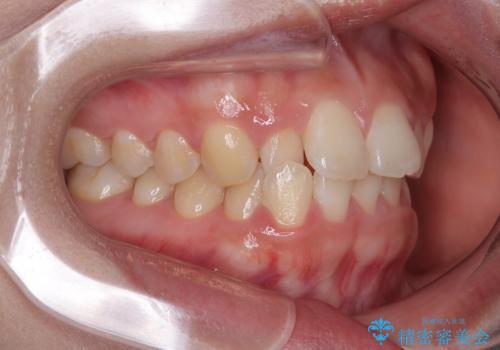 目立ちにくい表側装置で1年完了!狭いアーチを側方拡大し前歯のデコボコを整えた症例の治療前