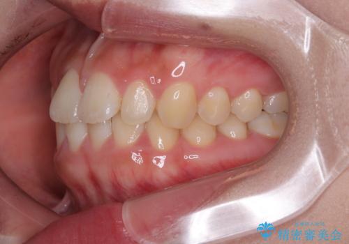 目立ちにくい表側装置で1年完了!狭いアーチを側方拡大し前歯のデコボコを整えた症例の治療前