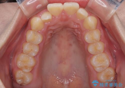 目立ちにくい表側装置で1年完了!狭いアーチを側方拡大し前歯のデコボコを整えた症例の治療前