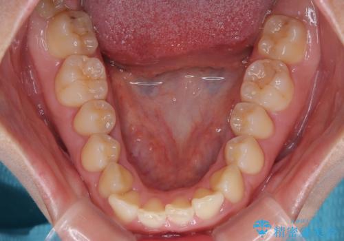 目立ちにくい表側装置で1年完了!狭いアーチを側方拡大し前歯のデコボコを整えた症例の治療前