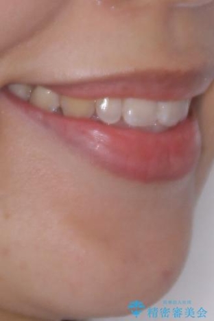 目立ちにくい表側装置で1年完了!狭いアーチを側方拡大し前歯のデコボコを整えた症例の治療後(顔貌)