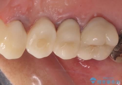 歯肉から膿が出る 破折した奥歯の抜歯即時埋入インプラントの治療後