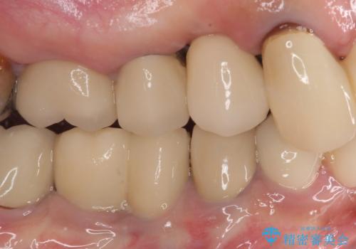 歯肉から膿が出る 破折した奥歯の抜歯即時埋入インプラントの治療後