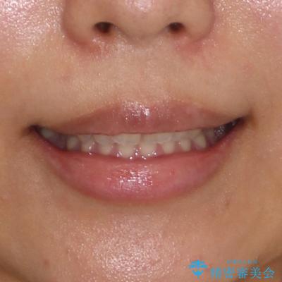 補助装置を併用して確実に インビザラインで奥歯の咬み合わせをしっかりと改善の治療前(顔貌)