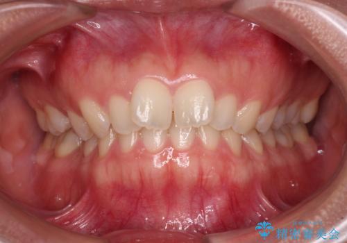 補助装置を併用して確実に インビザラインで奥歯の咬み合わせをしっかりと改善の症例 治療前