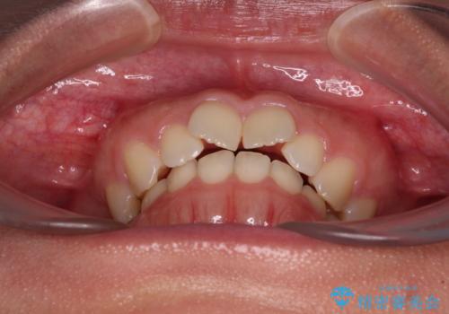 補助装置を併用して確実に インビザラインで奥歯の咬み合わせをしっかりと改善の治療前