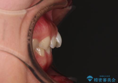 補助装置を併用して確実に インビザラインで奥歯の咬み合わせをしっかりと改善の治療前