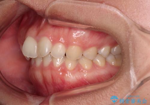 補助装置を併用して確実に インビザラインで奥歯の咬み合わせをしっかりと改善の治療前