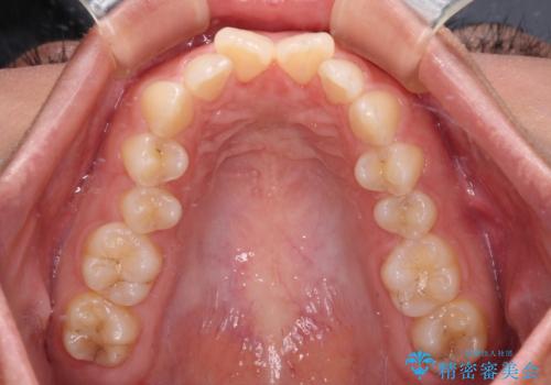 補助装置を併用して確実に インビザラインで奥歯の咬み合わせをしっかりと改善の治療前